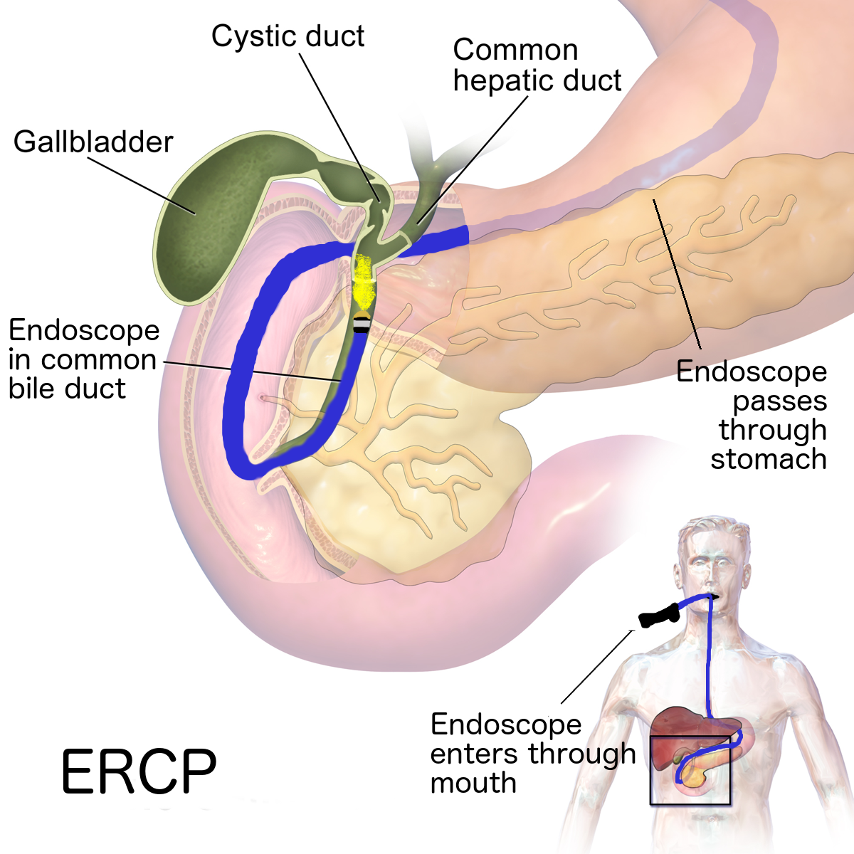 ERCP (1)