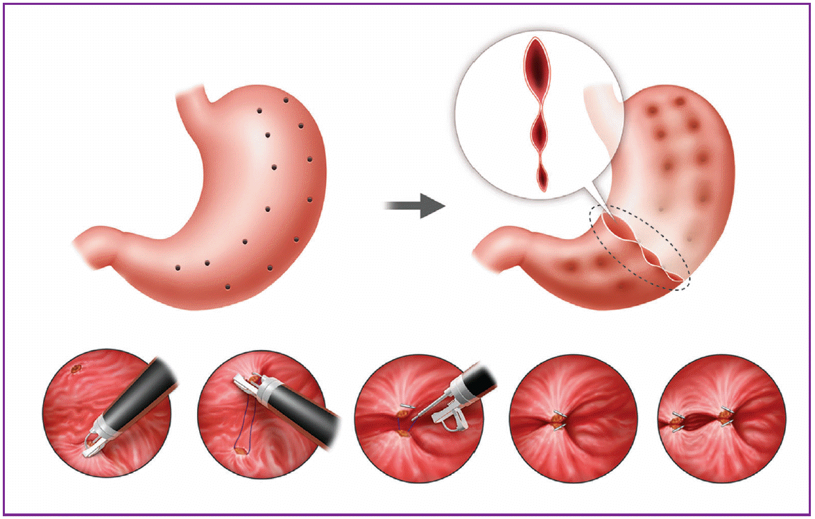 Endoscopic Gastroplasty