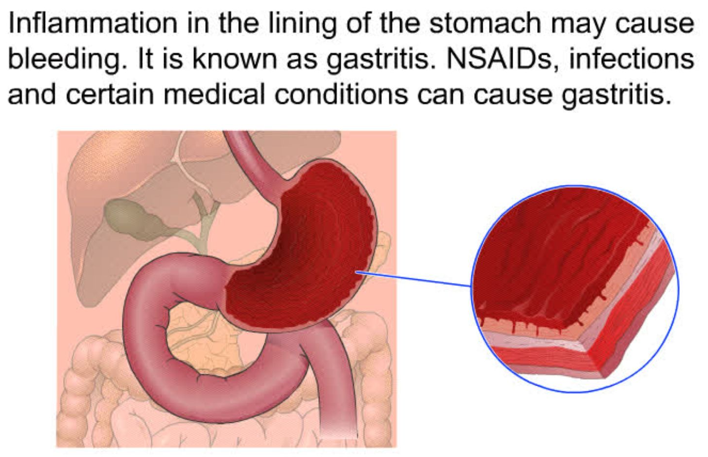 GASTROINTESTINAL BLEEDING.jpg