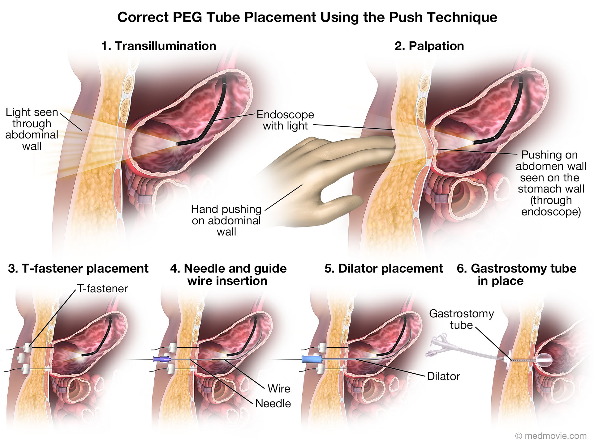 This illustration depicts the step used to insert a percutaneous gastrostomy tube throught the abdominal wall using the push technique.