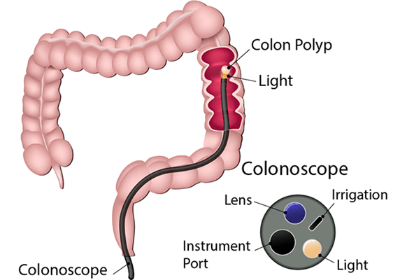Sigmoidoscopy Outline