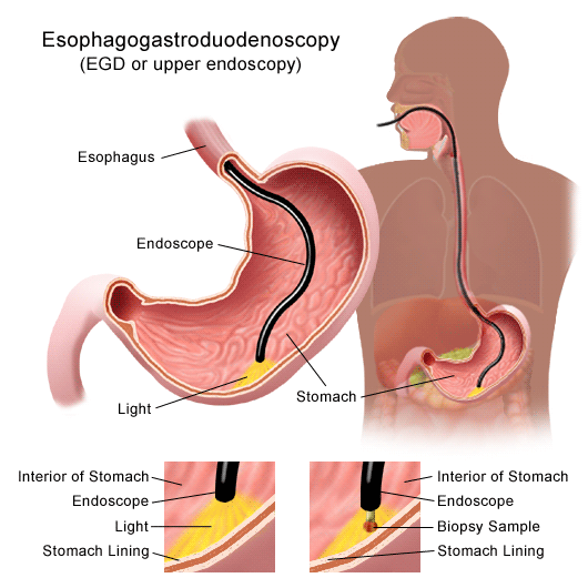 Upper Gi Endoscopy