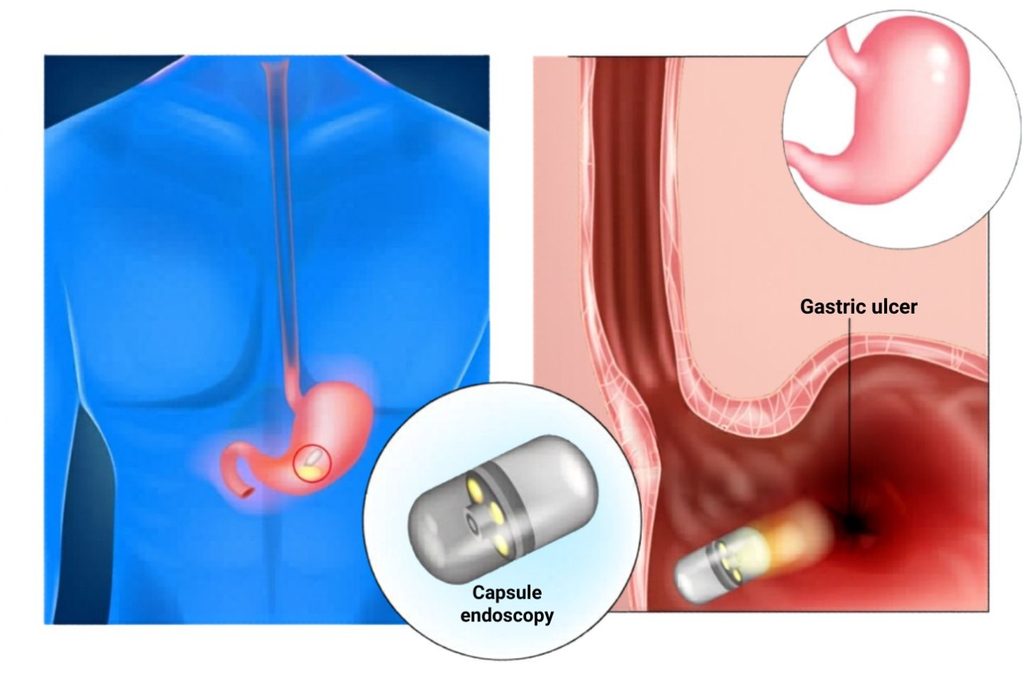 capsule-endoscopy