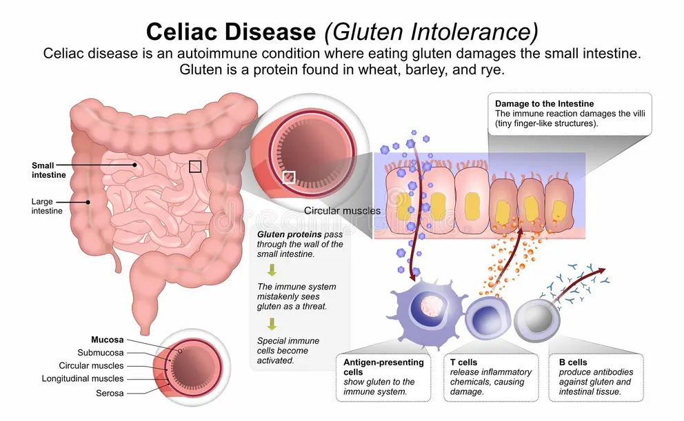 celiac disease