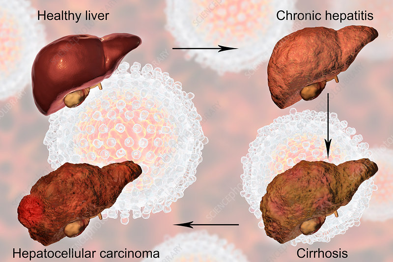 Human liver showing stages of liver disease during hepatitis C viral infection, computer illustration.