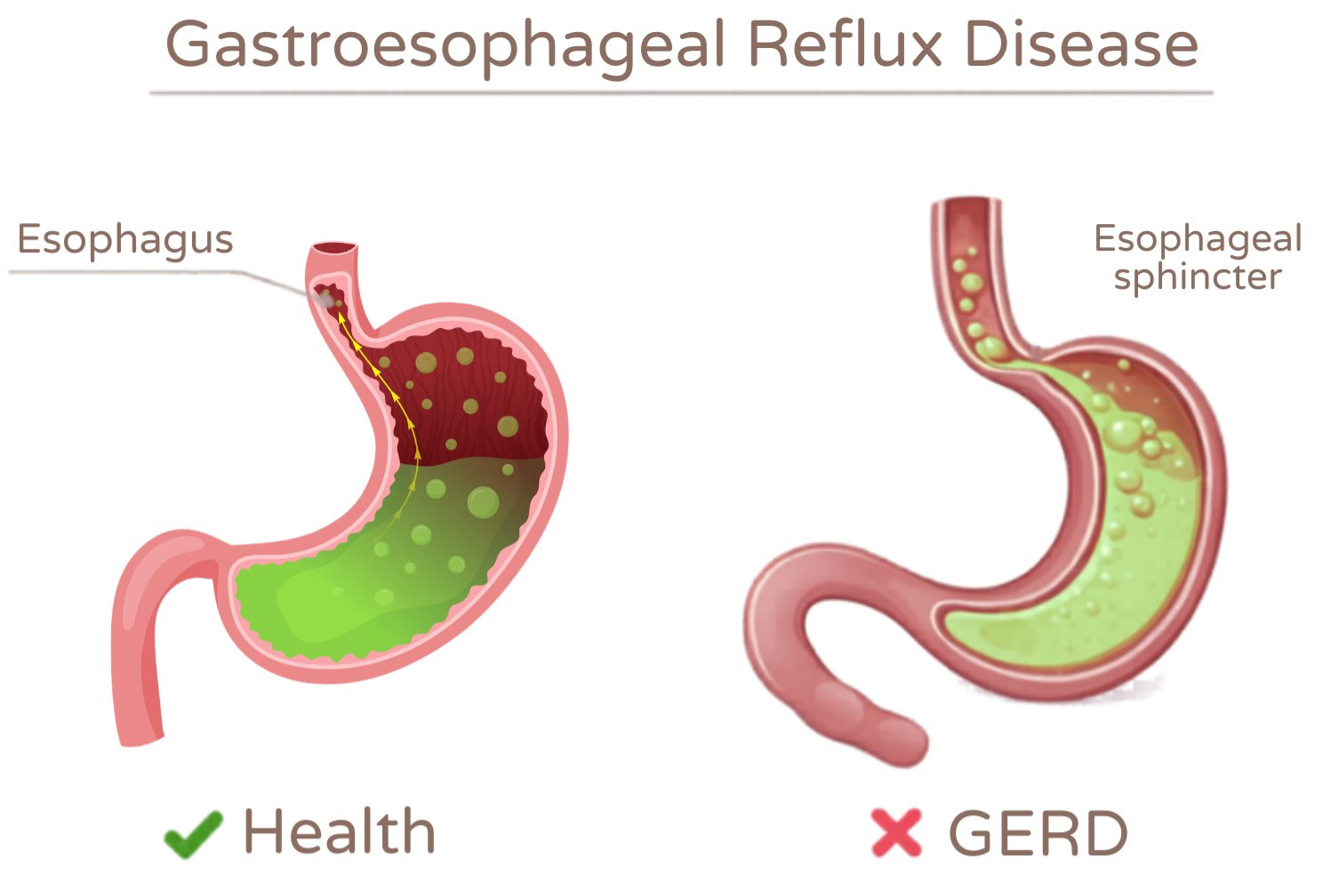 esophaegal reflux
