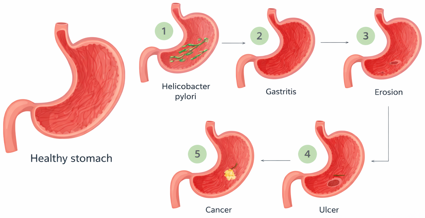 gastritis-and-ulcer-treatment