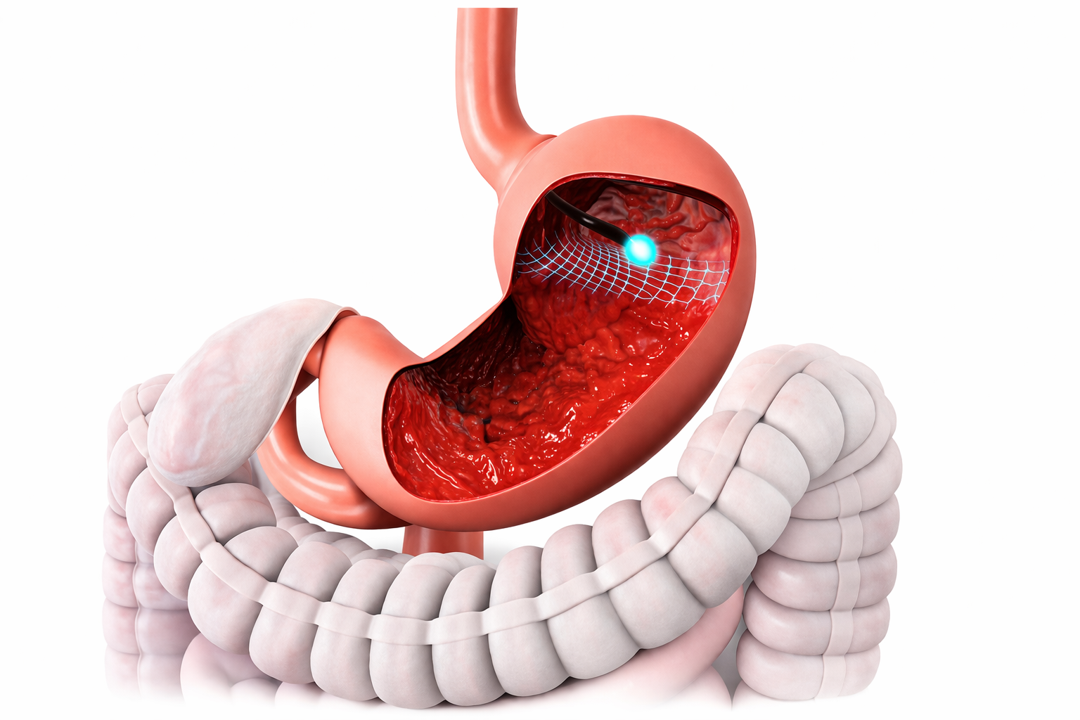 therapotic endoscopy
