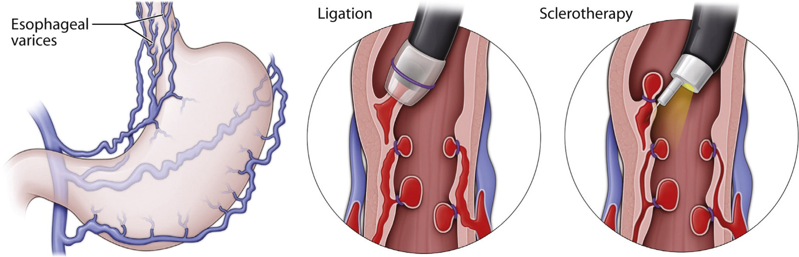 variceal-band-ligation-in-ghaziabad